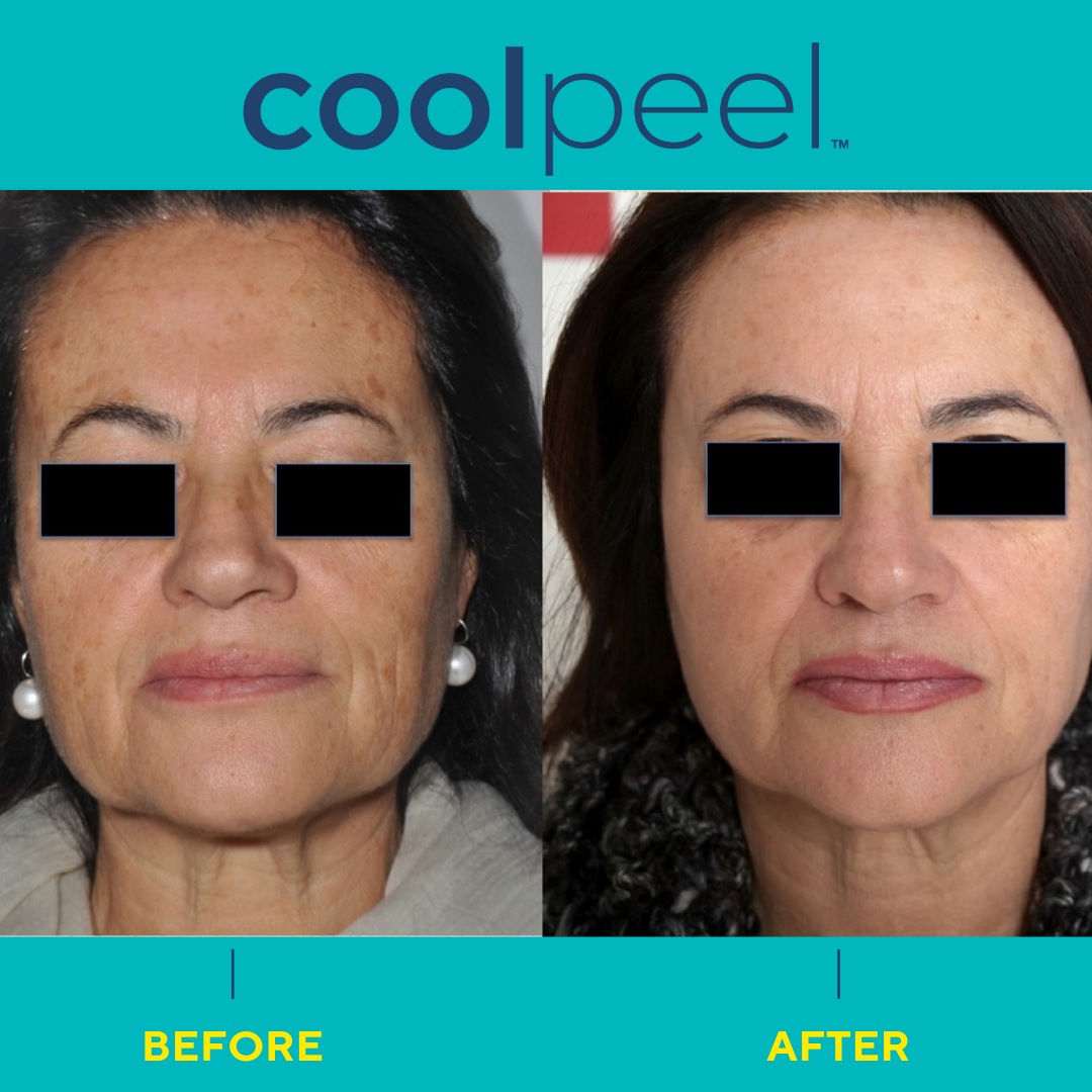 CoolPeel