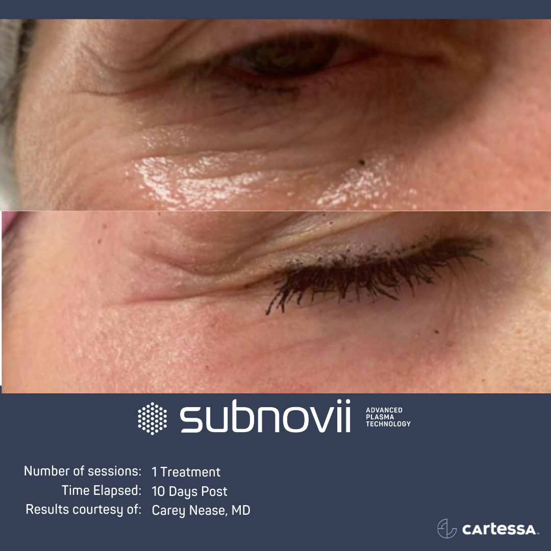 Subnovii Treatment