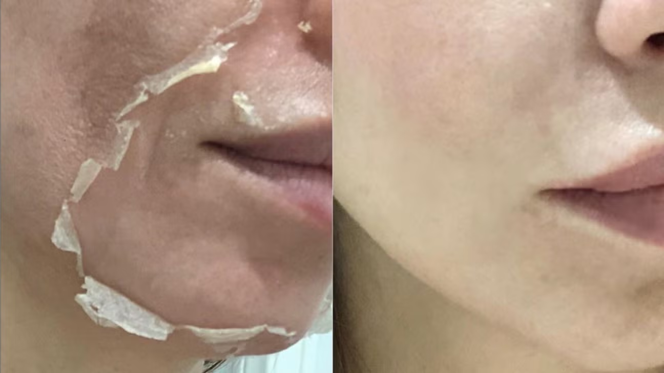 TCA Chemical Peel