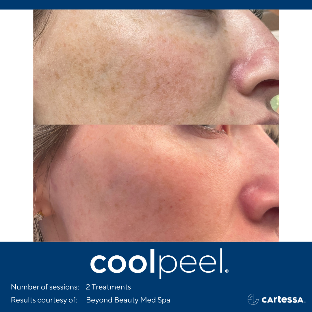 CoolPeel