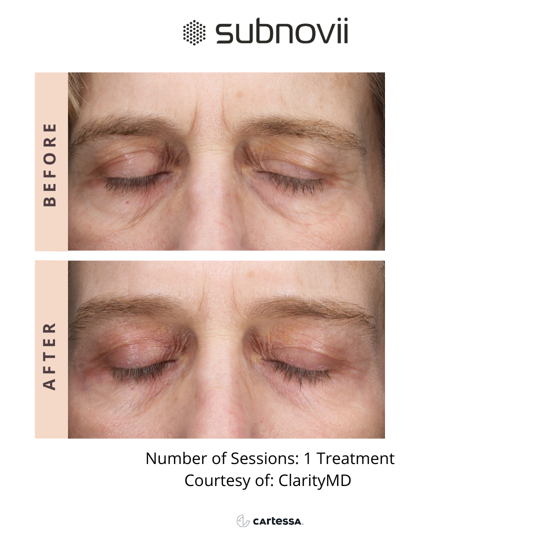Subnovii Treatment