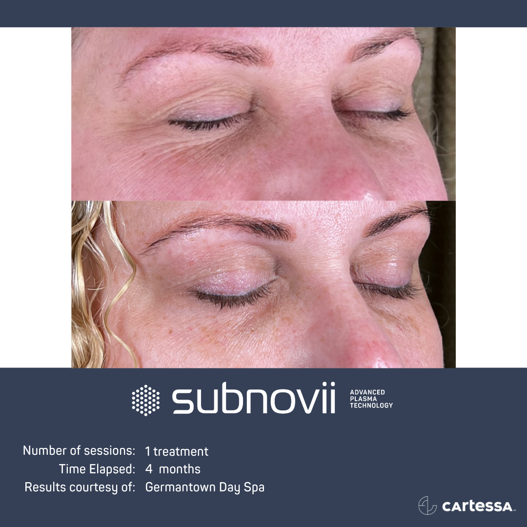 Subnovii Treatment