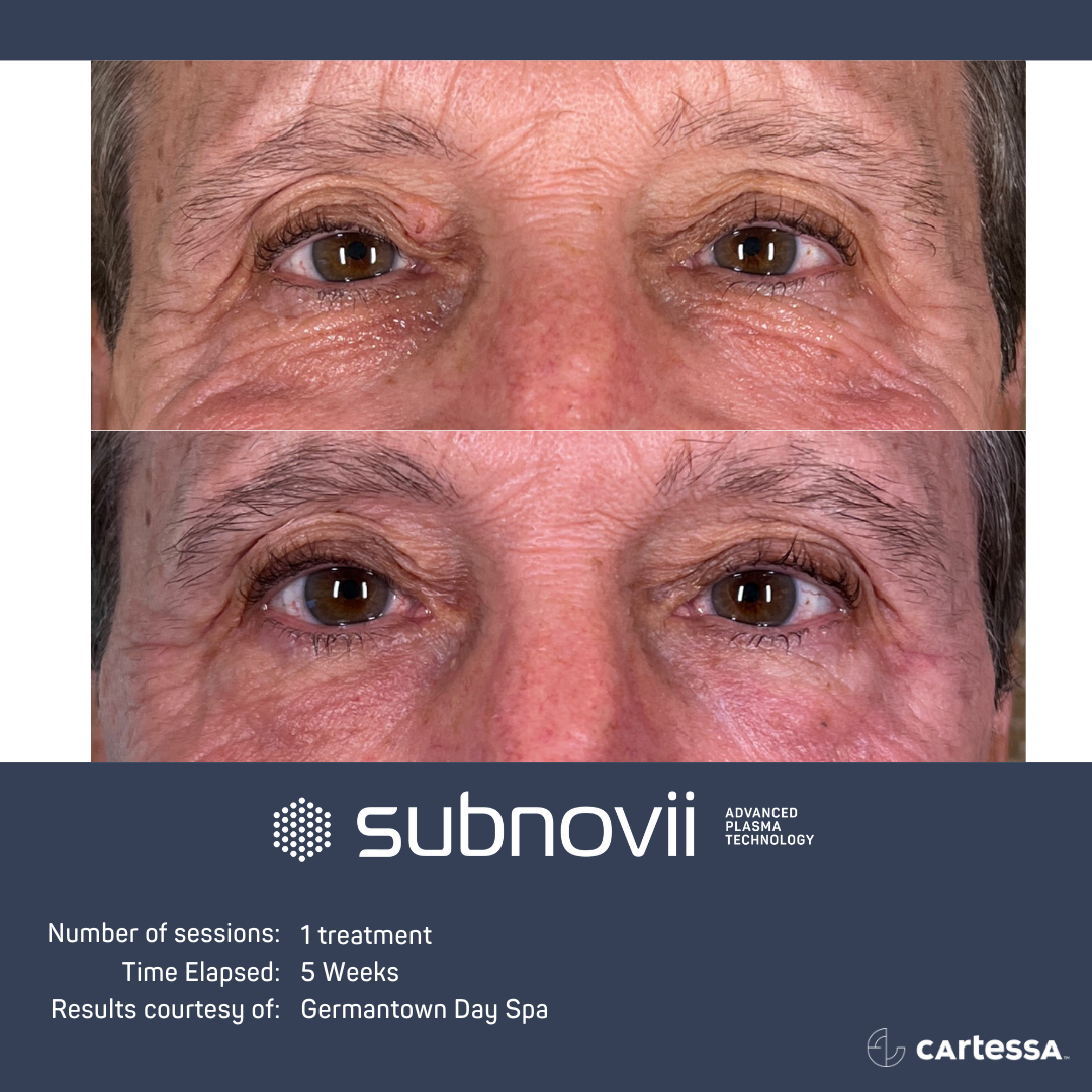 Subnovii Treatment