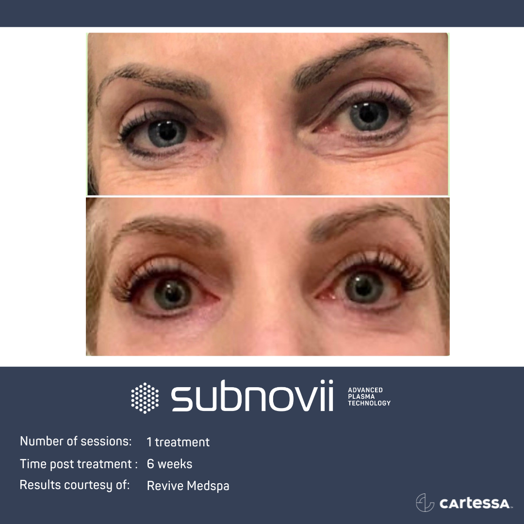 Subnovii Treatment